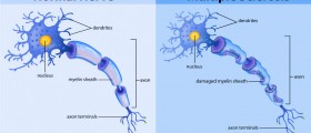 Defining Multiple Sclerosis: What’s the Role of Myelin, Immune-mediated Disease And T-Cells